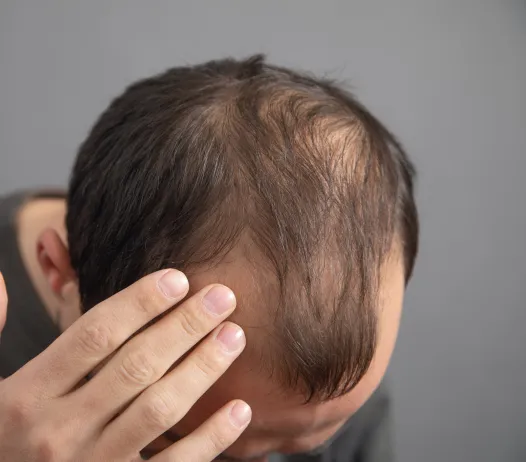 Male Hair Loss